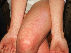 Zika-Virus-2.rash